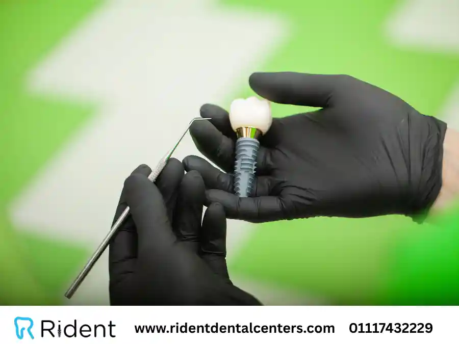 هل يمكن زراعة الاسنان لمرضى السكر؟